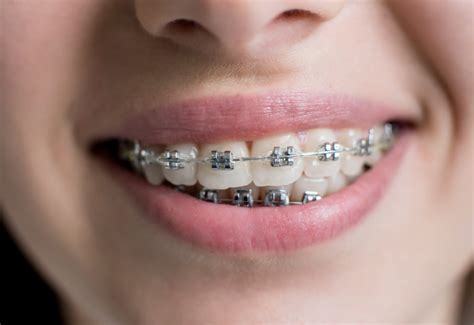 precio de brackets metalicos españa|cuanto cuestan los brackets.